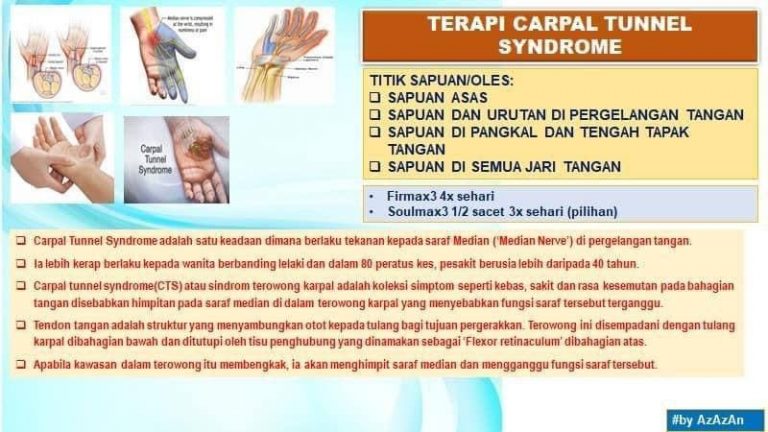 Terapi Carpal Tunnel Syndrome