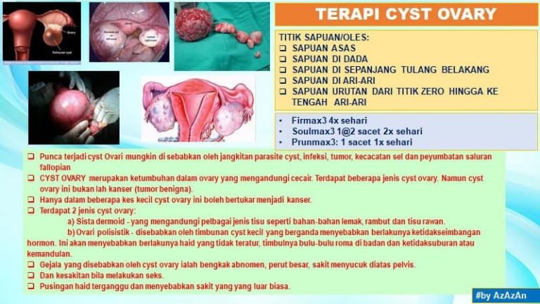 Terapi Cyst Ovary